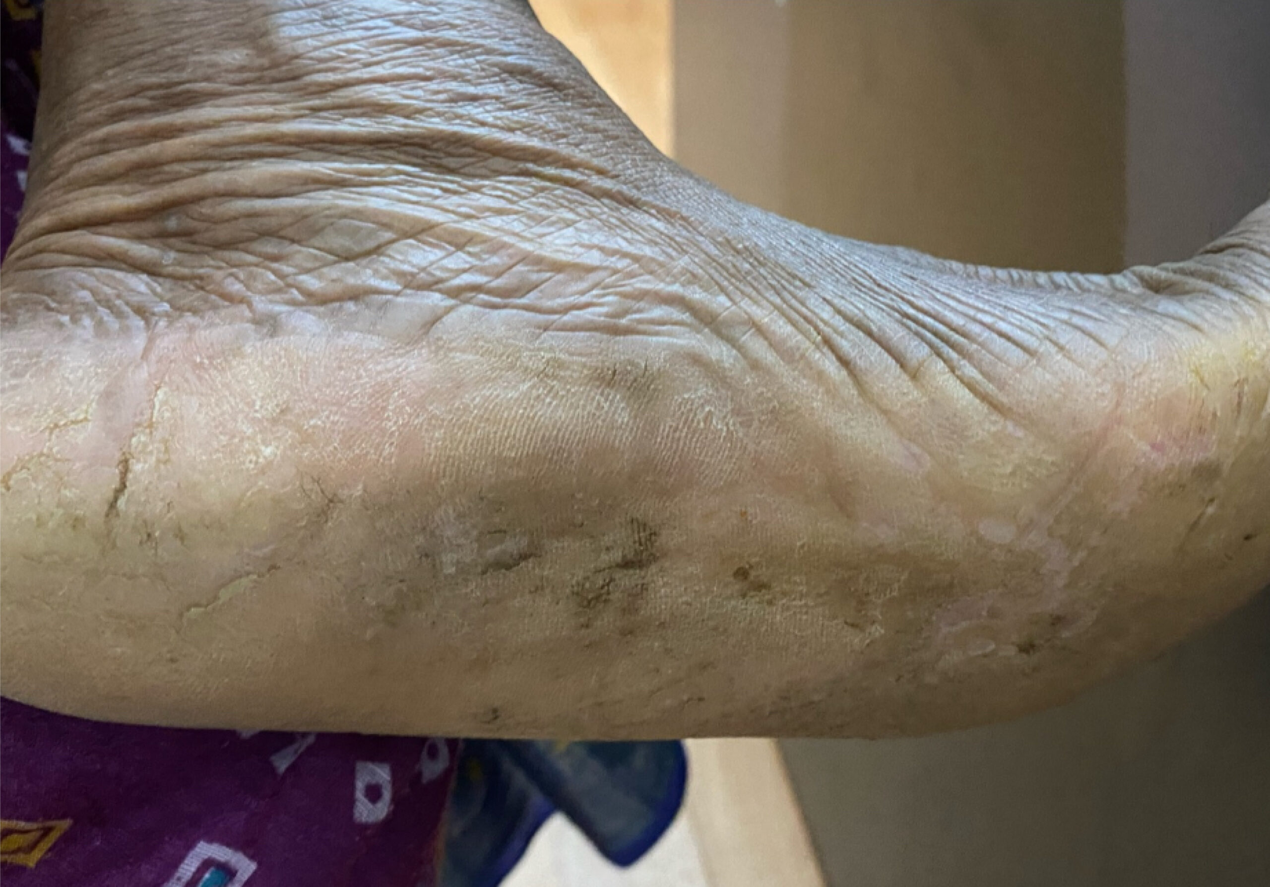 AFTER TREATMENT WITH ORAL MED