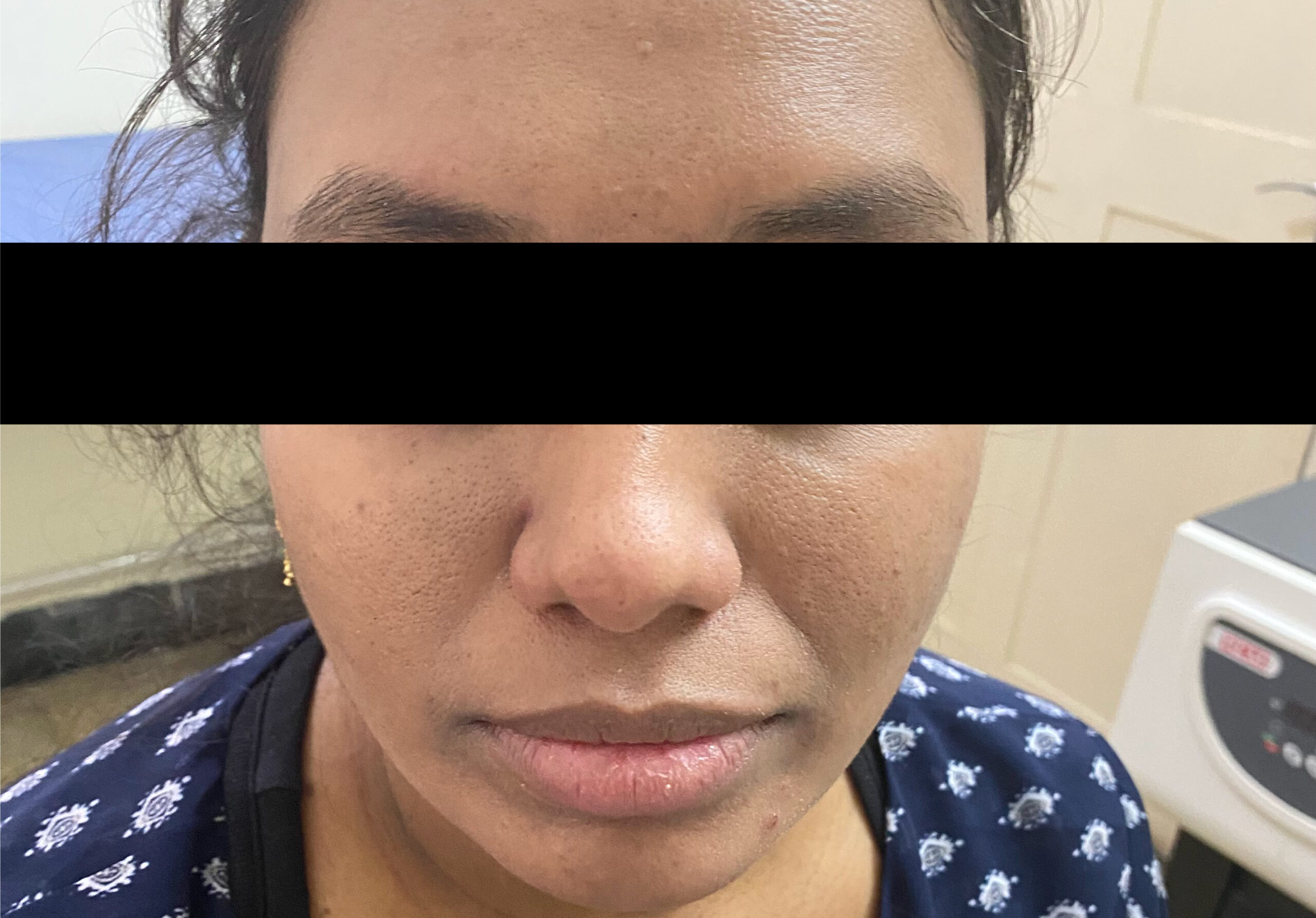 FACE PIGMENTATION AFTER, COSMELAN PEEL TREATMENT& ORAL MEDICATIONS