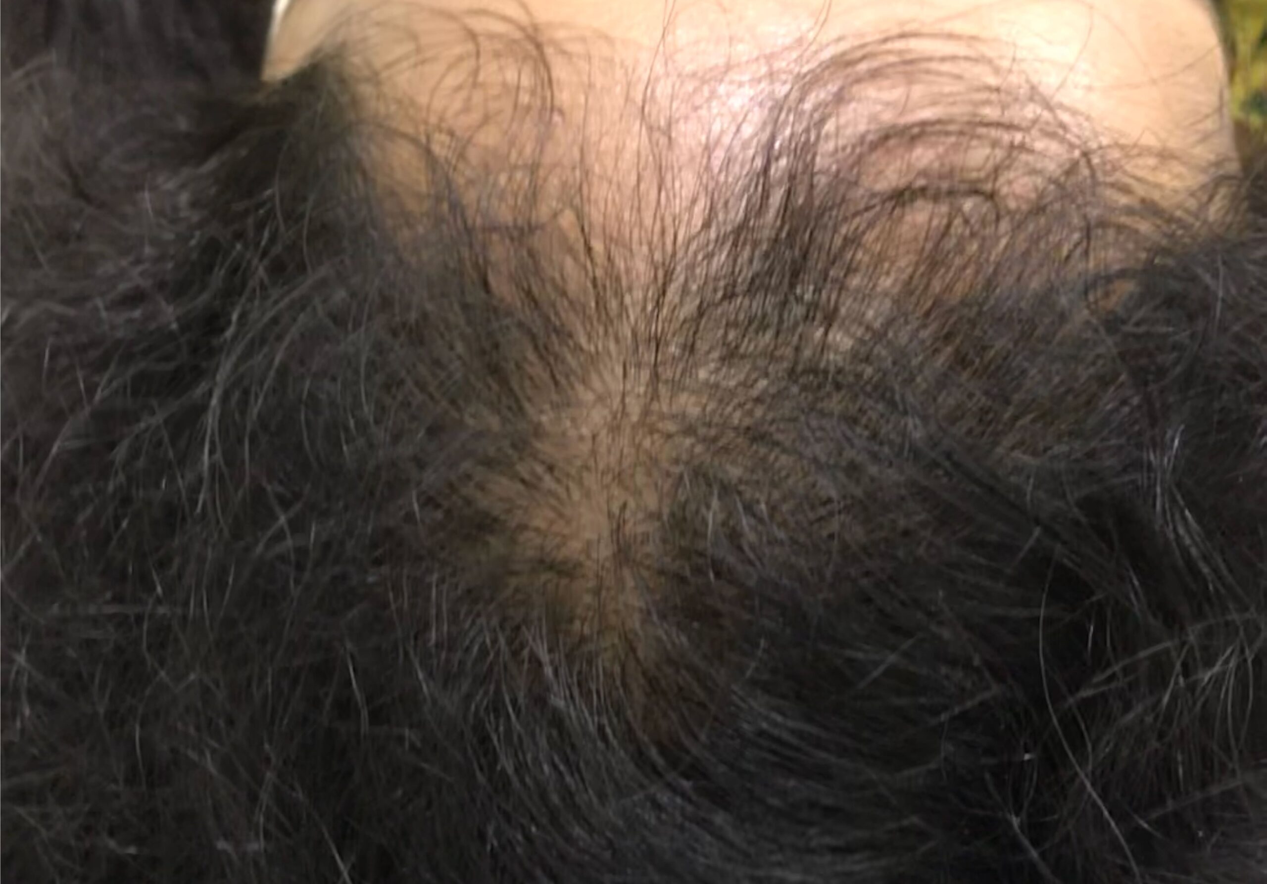 FEMALE hair loss FullSizeRender