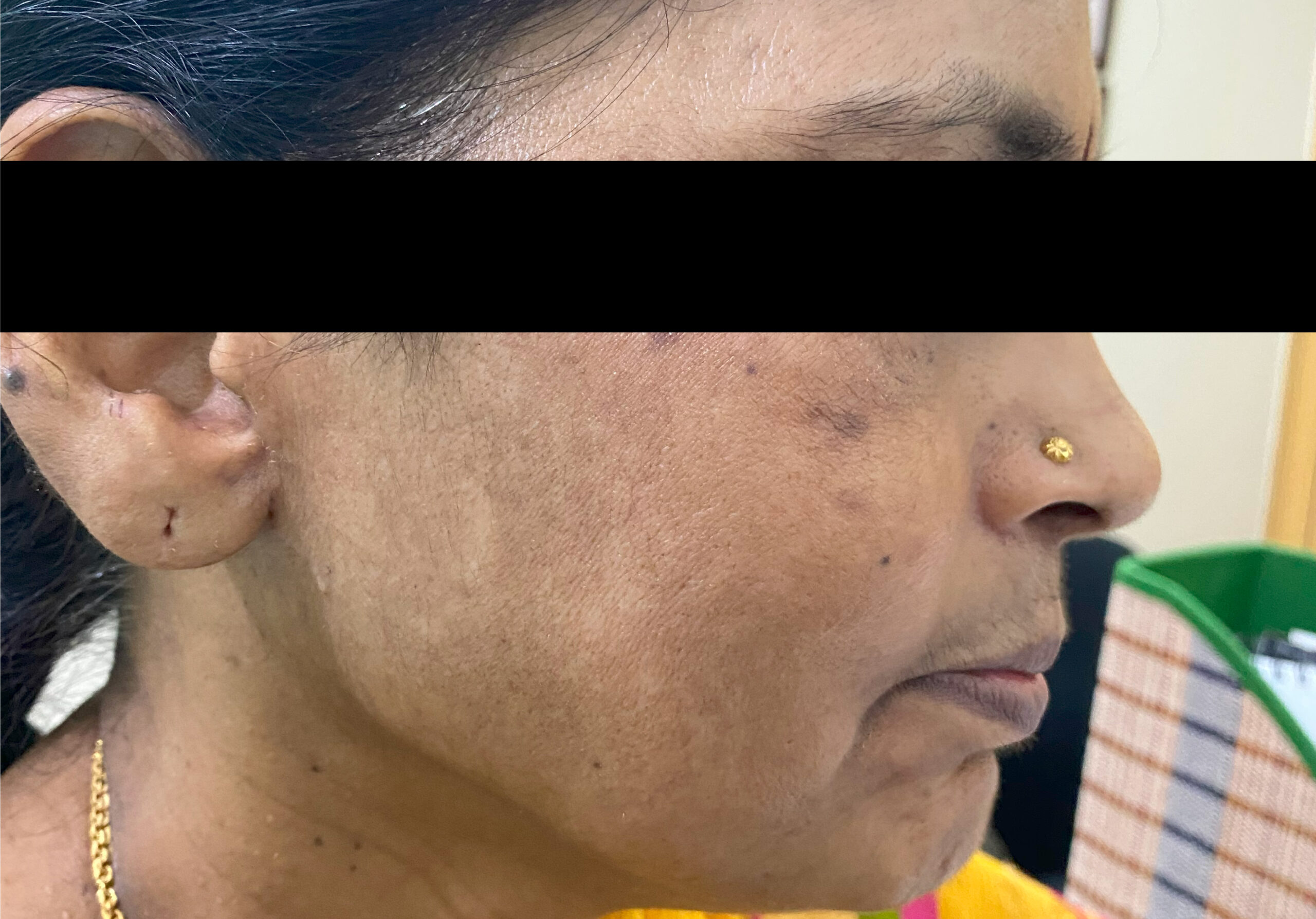 MELASMA 3- TREATED WITH MESOTHERAPY + COSMELAN PEEL