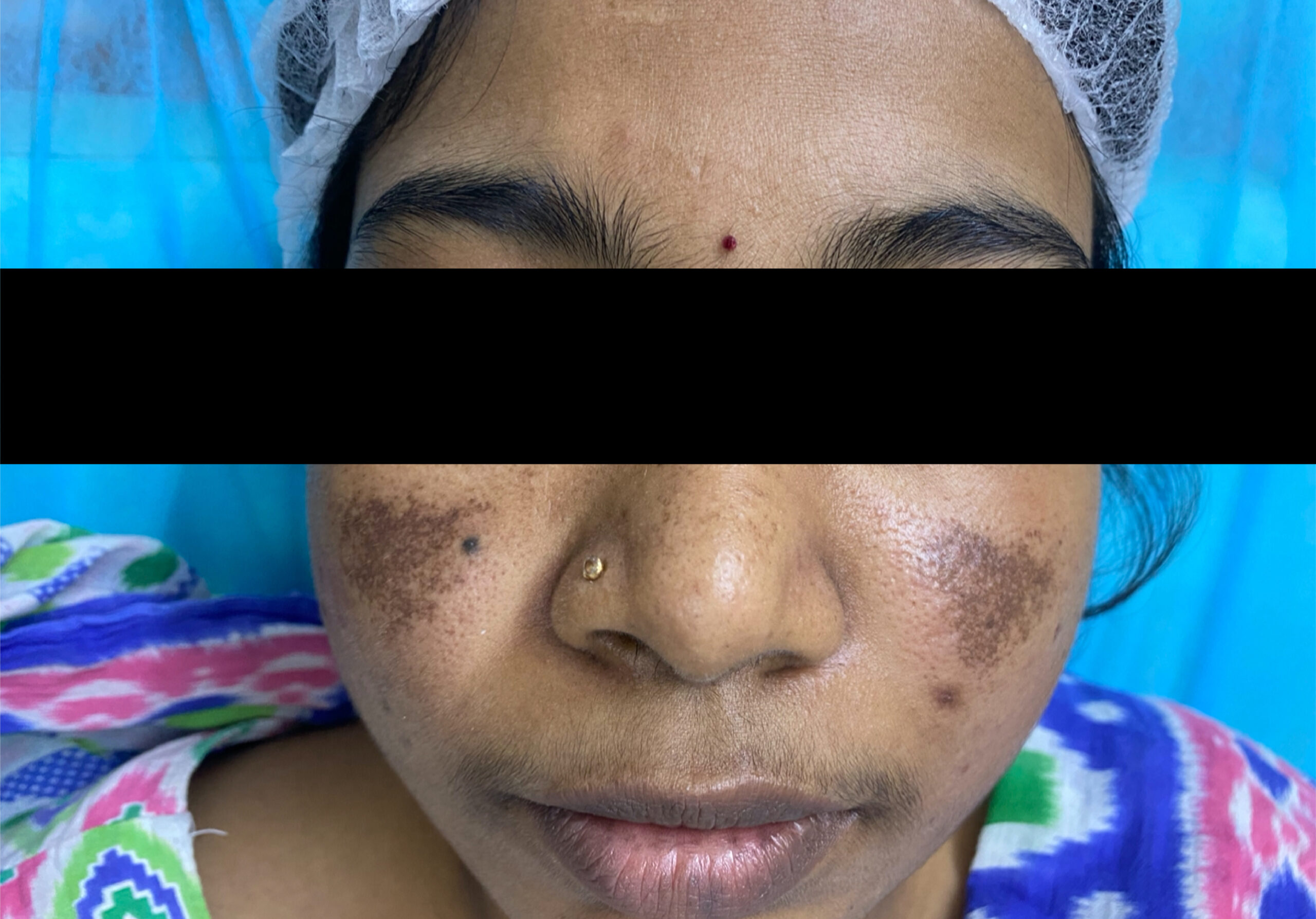 MELASMA PATIENT 1 - COSMELAN SPOT TREATMENTIMG_2466