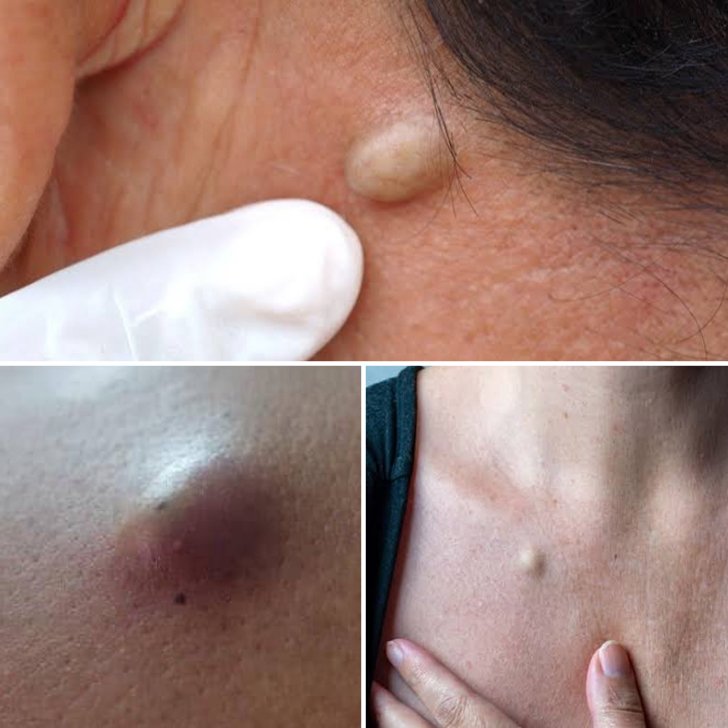 Sebaceous Cyst Treatment