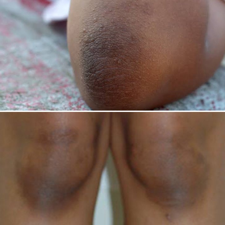 dark knees and elbows treatment