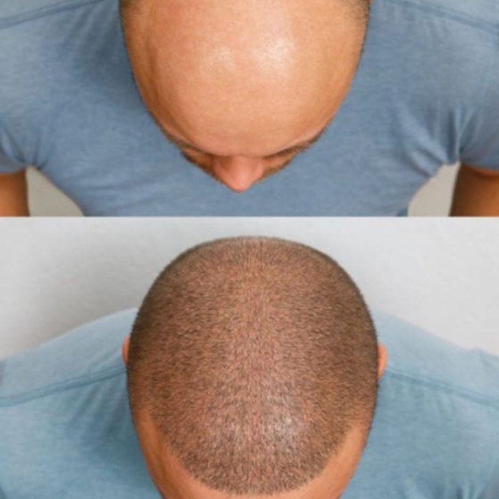 hair transplantation