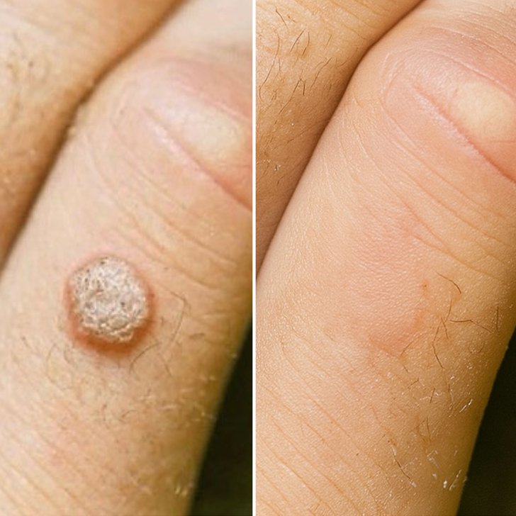 wart removal