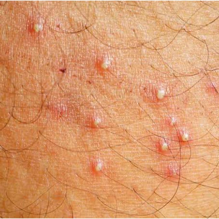 body folliculitis