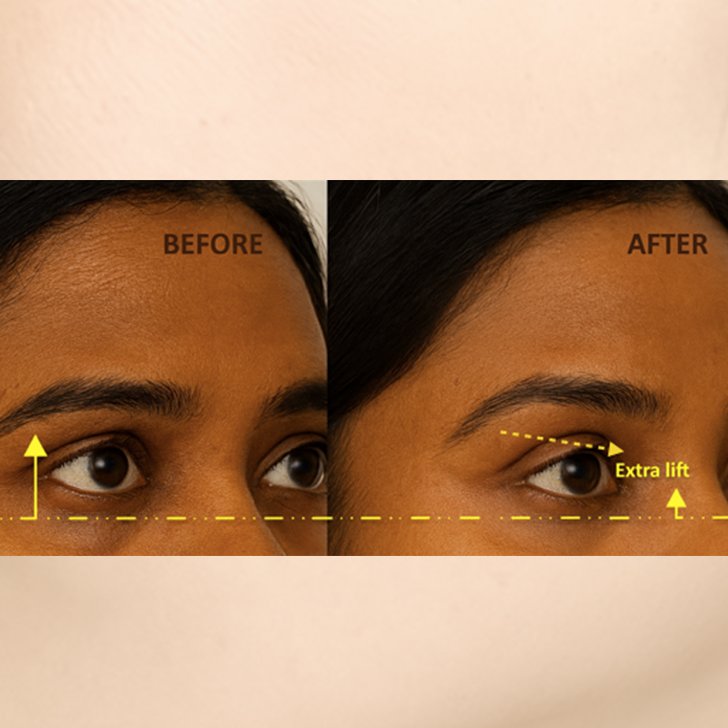 eyebrow lifting