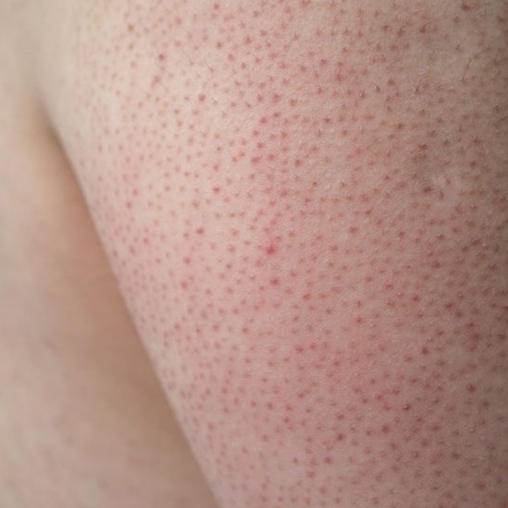 kerotosis pilaris