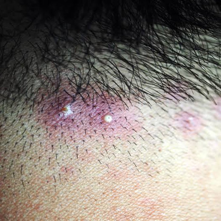 scalp folliculitis