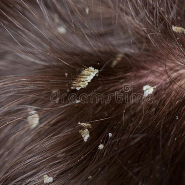 seborrheic dermatitis