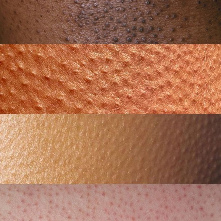 Keratosis pilaris various