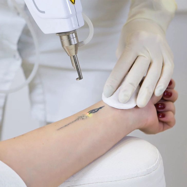 Tattoo Removal